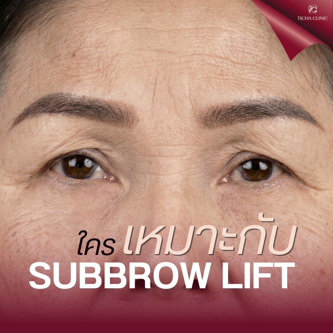 3.2 TC _ Subbrow Lift คืออะไร_ ทำไมช่วยแก้ปัญหาตาตก โดยไม่ต้องทำตาสองชั้นใหม่