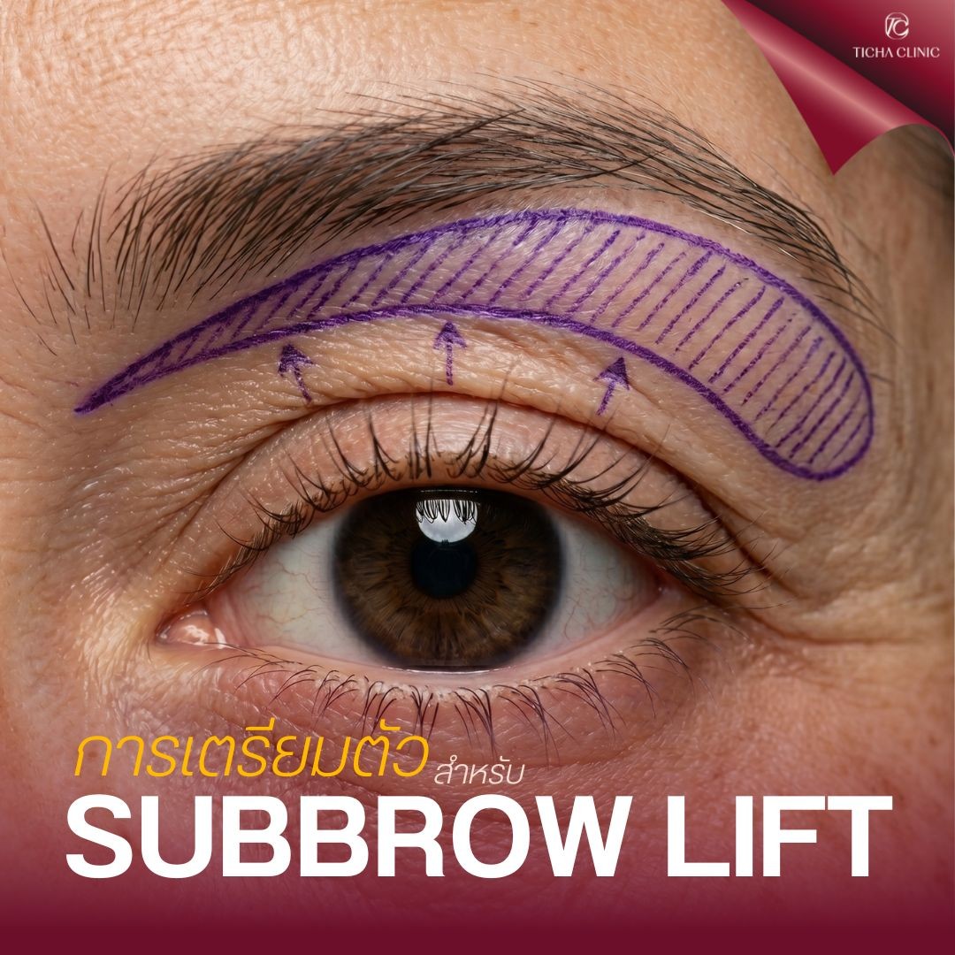 3.3 TC _ Subbrow Lift คืออะไร_ ทำไมช่วยแก้ปัญหาตาตก โดยไม่ต้องทำตาสองชั้นใหม่
