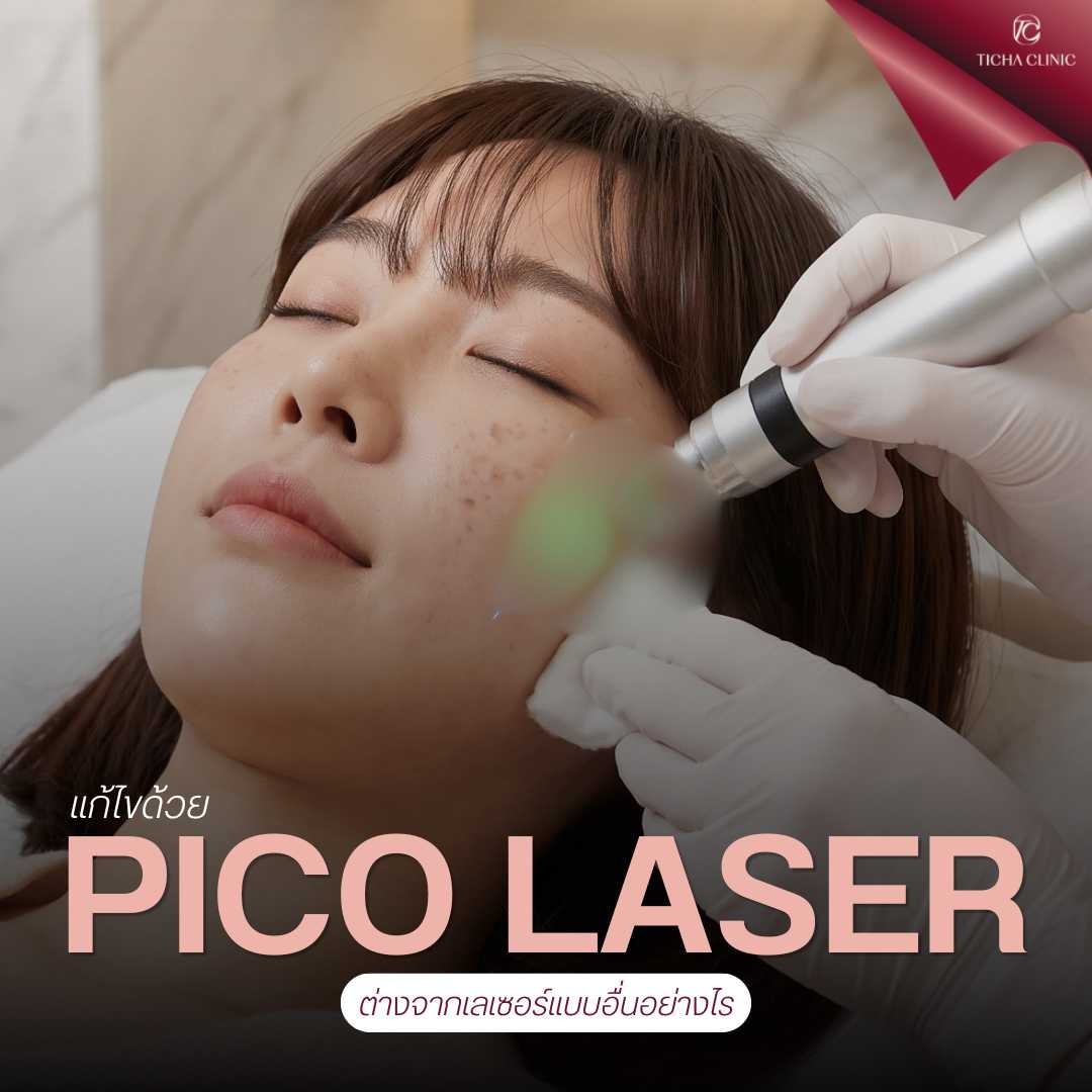 48.3 TC _ ส่องกระจกทีไรเครียดเพราะรอยดำสิวและฝ้า รีวิวเคลียร์ผิวใสด้วย Pico Laser นวัตกรรมปราบเม็ดสีที่ฮิตที่สุดในตอนนี้