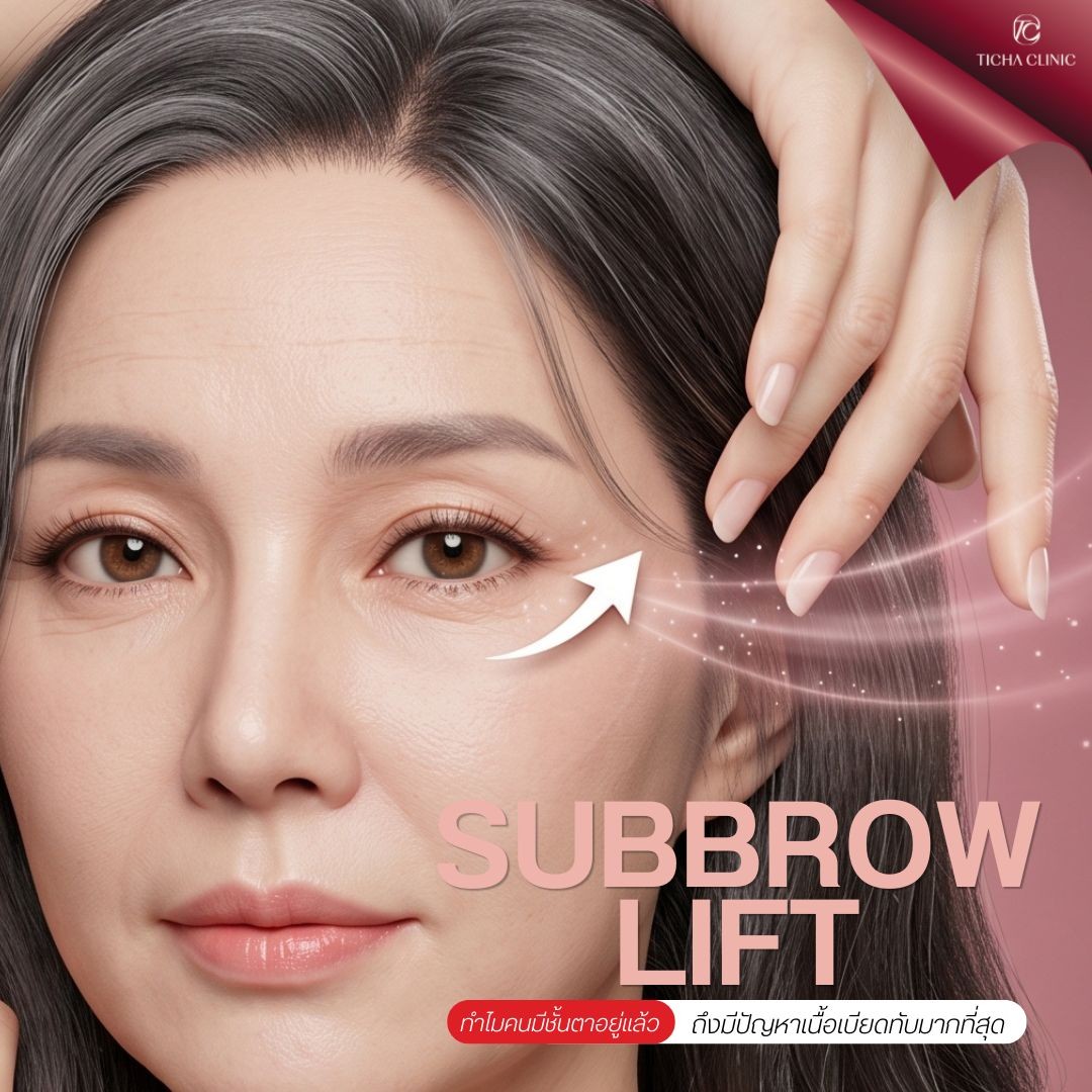 49.2 TC _ รีวิว Subbrow Lift แก้ไขหนังตาตกทับชั้นตา สำหรับคนมีชั้นตาอยู่แล้วแต่โดนเนื้อเบียด