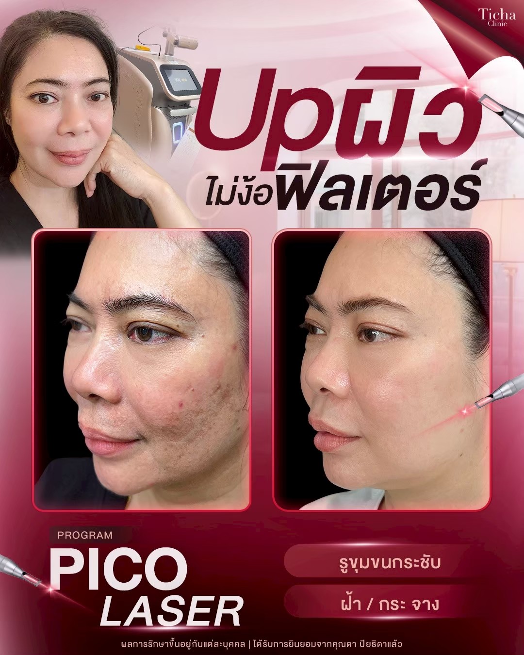 LINE_ALBUM_Skin Ticha - 3_260811_2