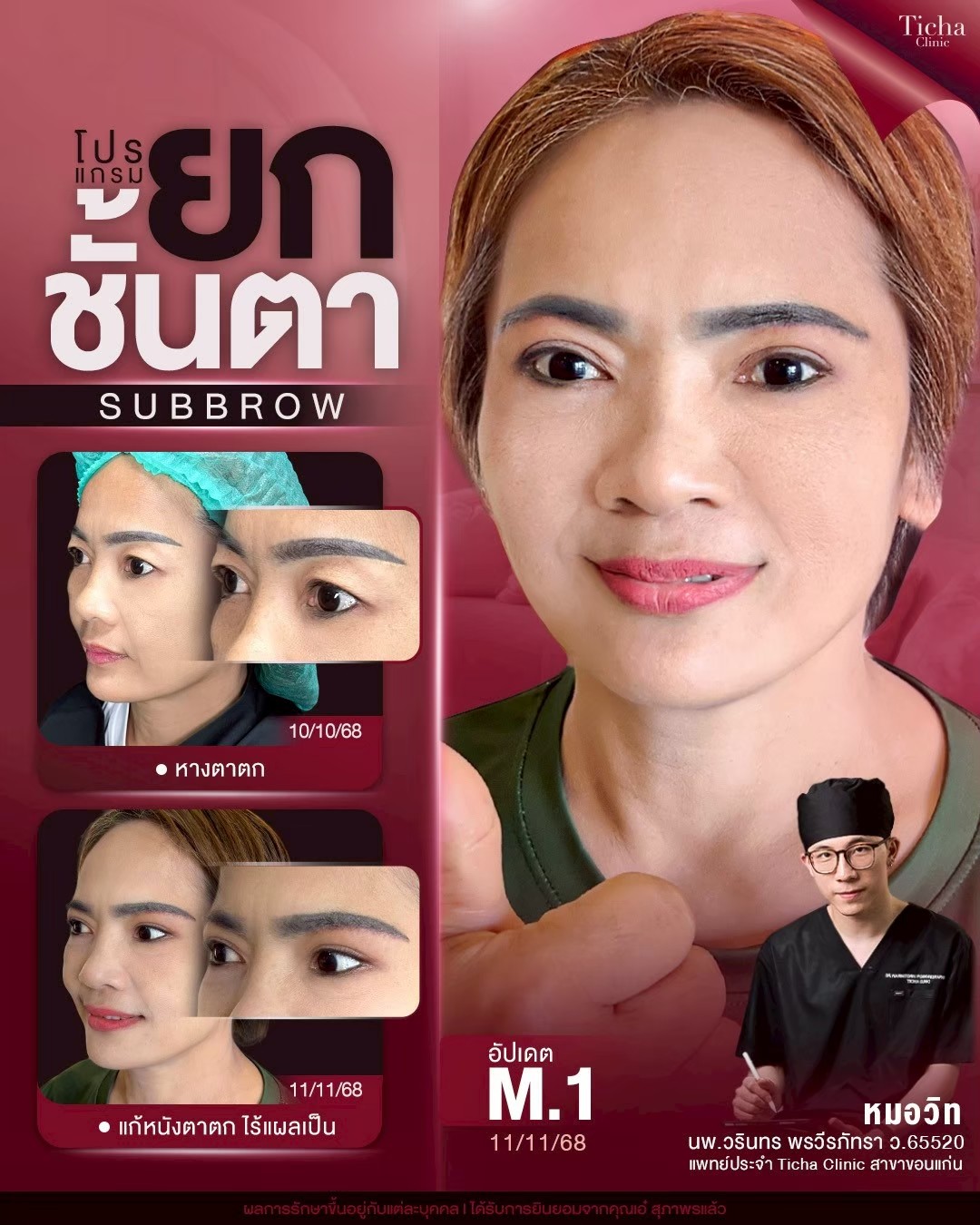 LINE_ALBUM_ซับบราว-Subbrow TC_260808_1