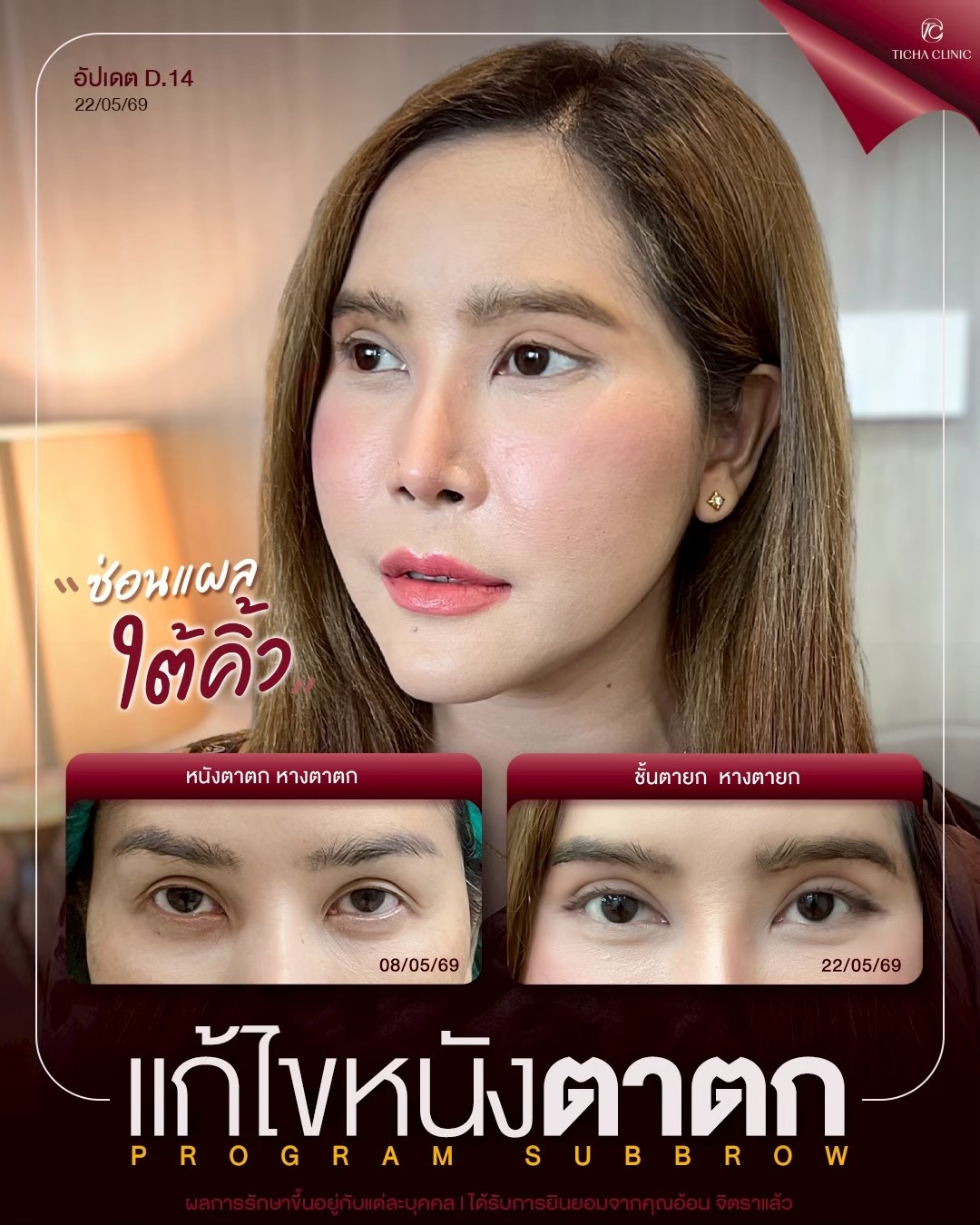 LINE_ALBUM_ซับบราว-Subbrow TC_260808_4