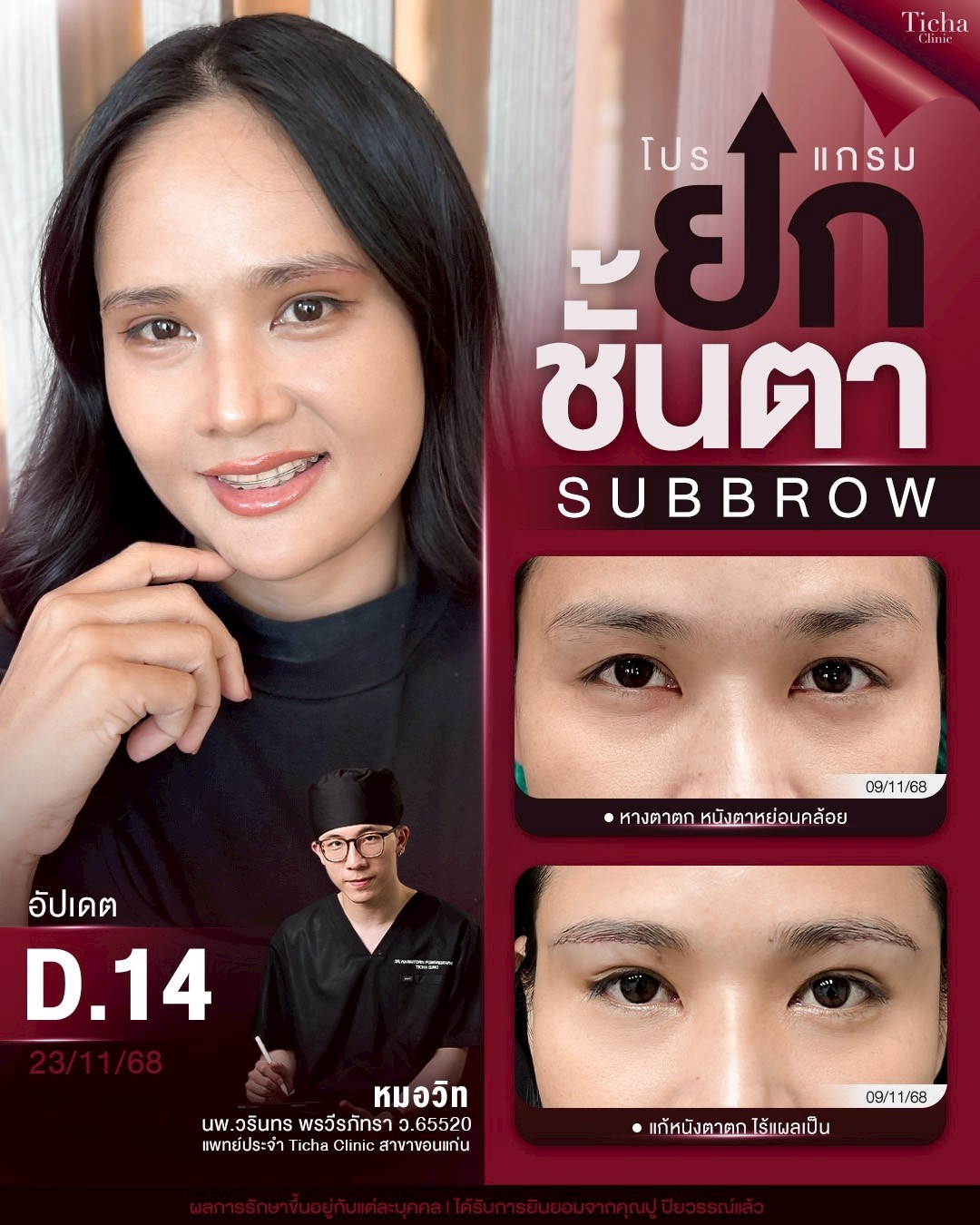 LINE_ALBUM_ซับบราว-Subbrow TC_260829_1