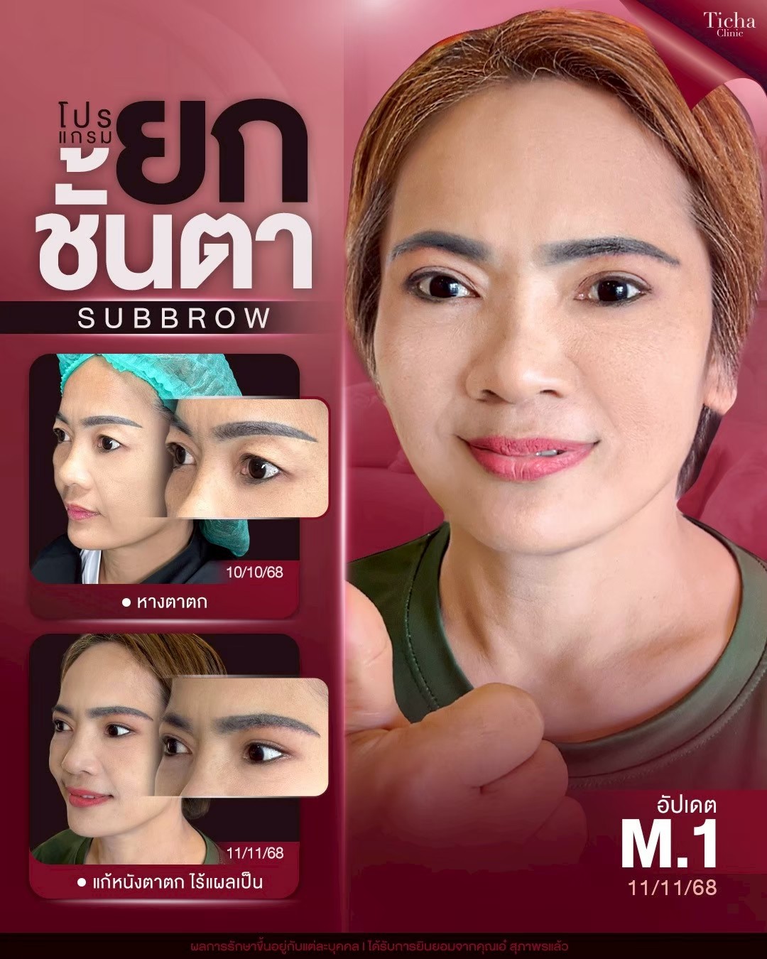 LINE_ALBUM_ซับบราว-Subbrow TC_260829_2