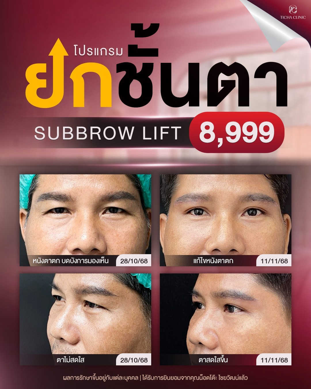 LINE_ALBUM_ซับบราว-Subbrow TC_260905_1