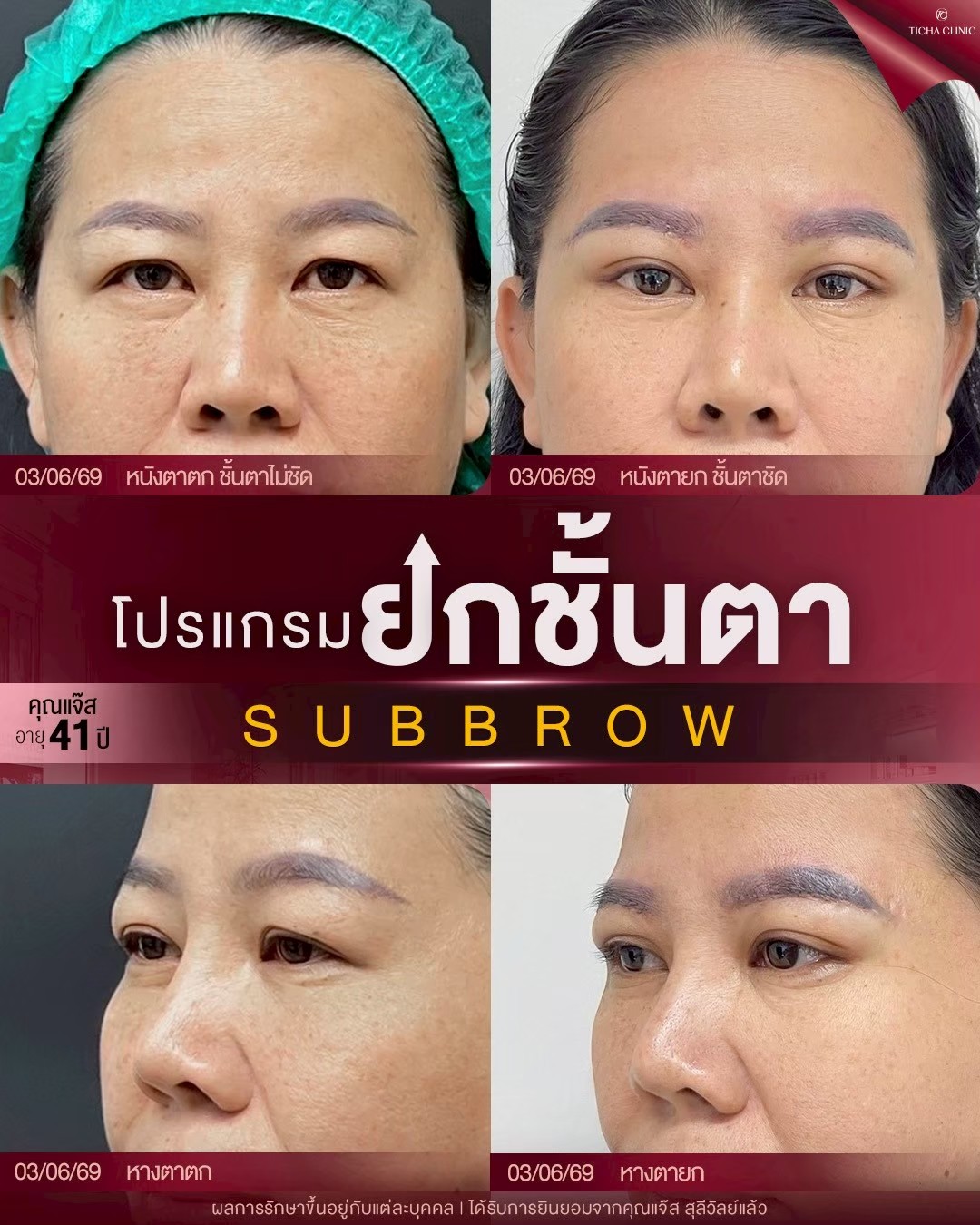 LINE_ALBUM_ซับบราว-Subbrow TC_260905_2