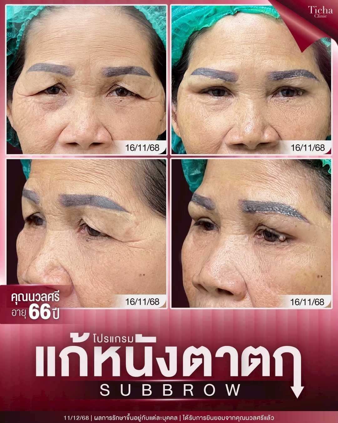 LINE_ALBUM_ซับบราว-Subbrow TC_260910_1