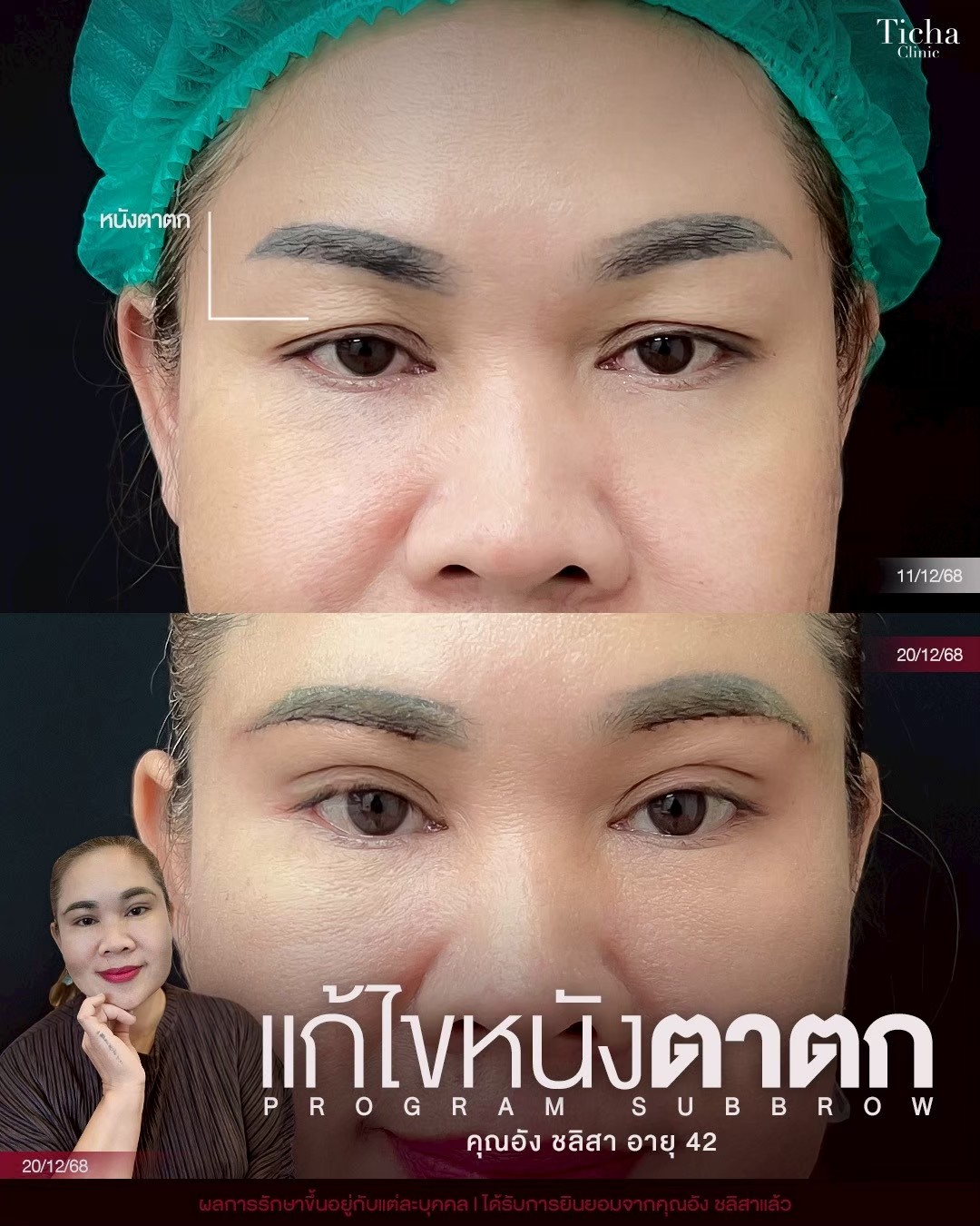LINE_ALBUM_ซับบราว-Subbrow TC_260910_2