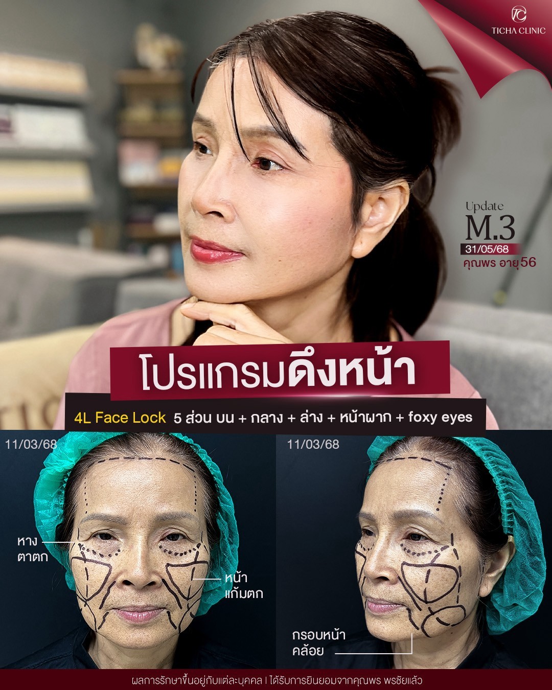 LINE_ALBUM_ดึงหน้า Face Lock TC_260908_1