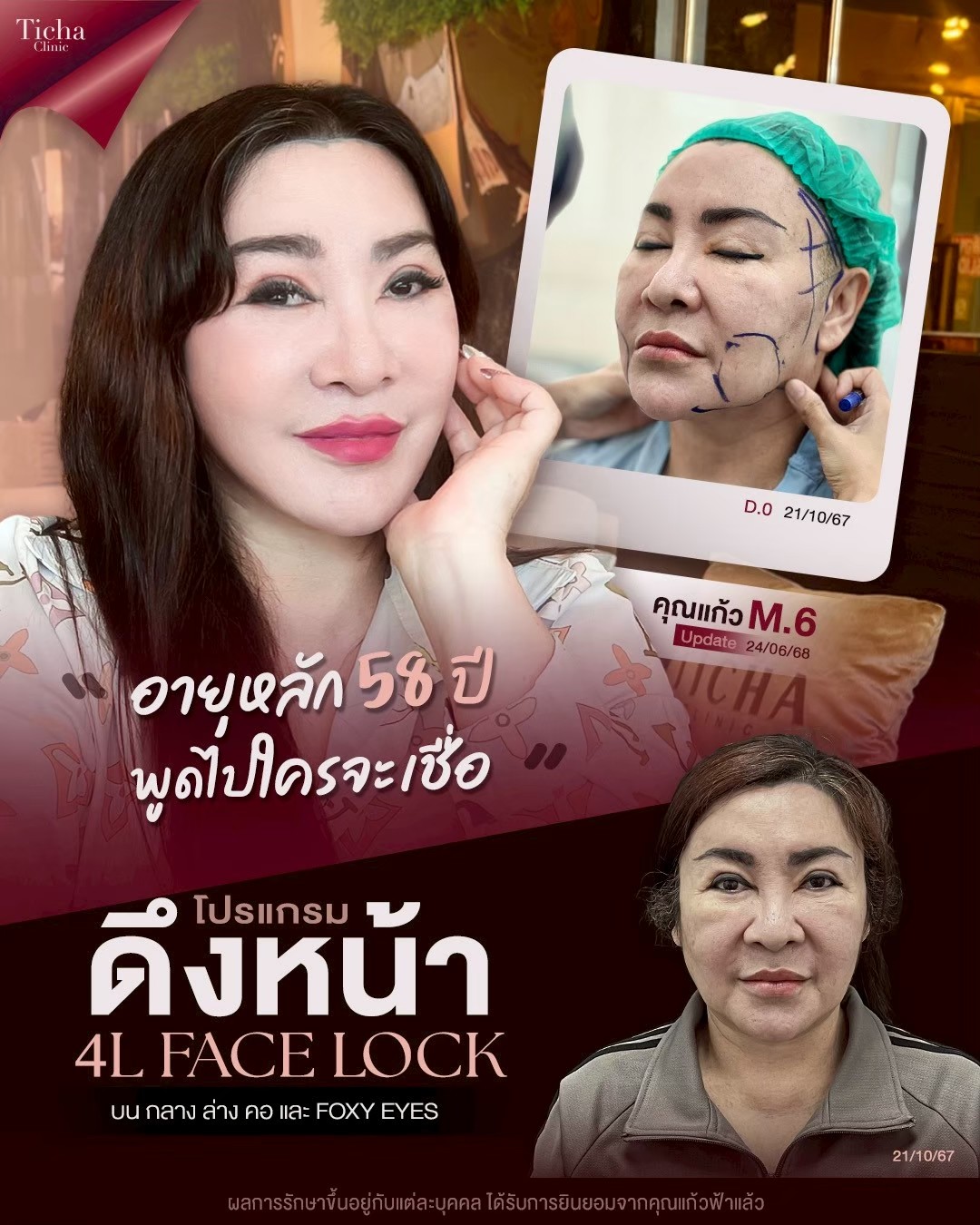LINE_ALBUM_ดึงหน้า Face Lock TC_260908_2