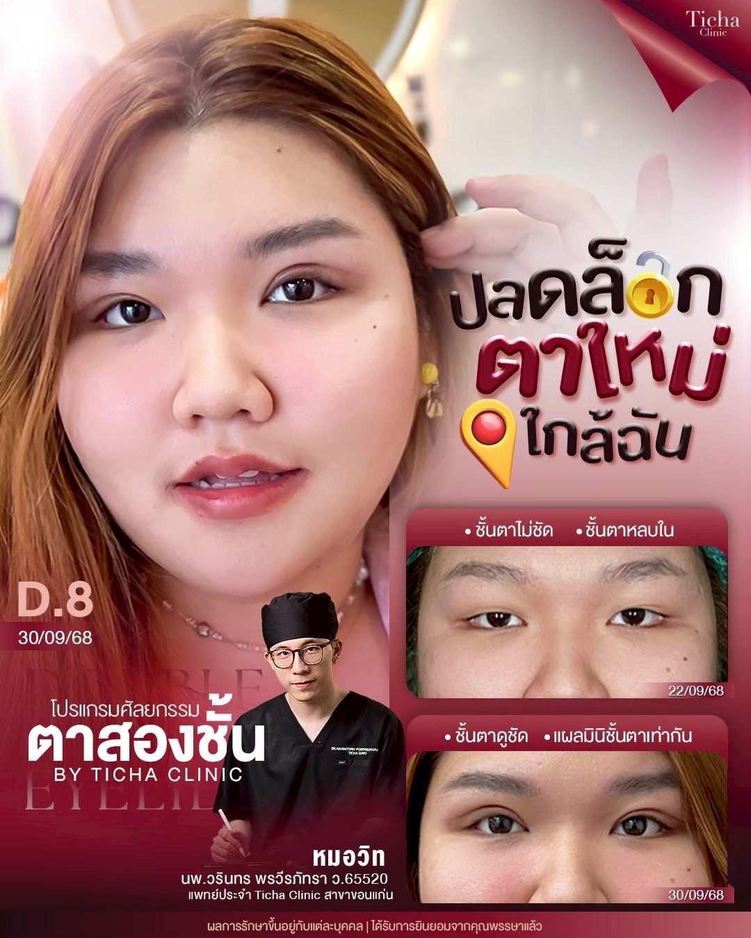 LINE_ALBUM_ศัล ตา2ชั้น - TICHA CLINIC_260818_1