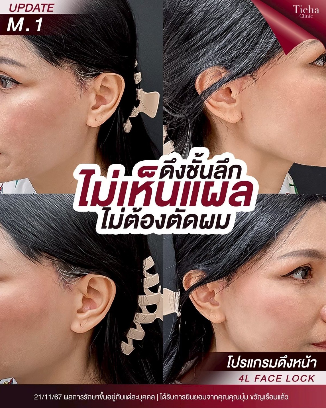 รอยแผลการผ่าตัดดึงหน้าจะหายไปภายในกี่วัน(1)