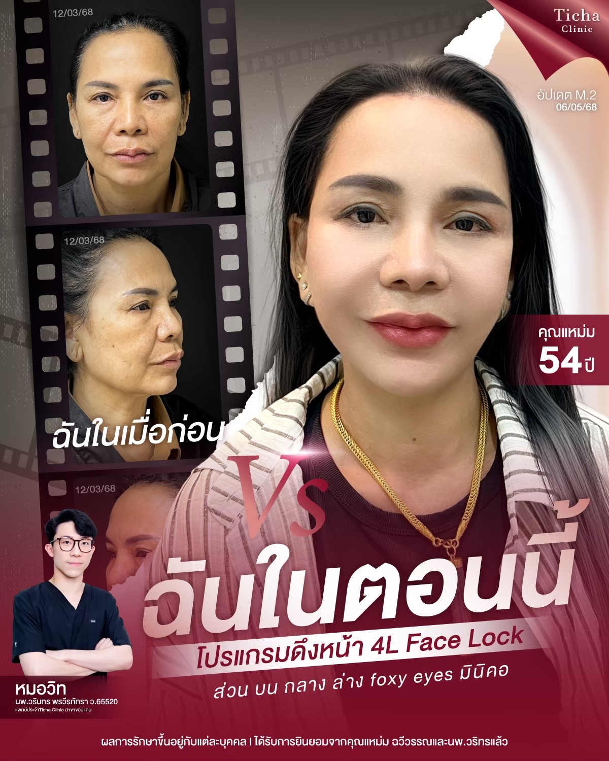 LINE_ALBUM_ดึงหน้า Face Lock TC_260826_1