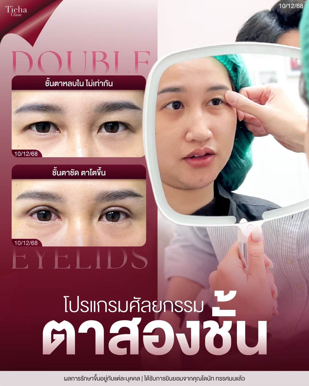LINE_ALBUM_ศัล ตา2ชั้น - TICHA CLINIC_260903_1