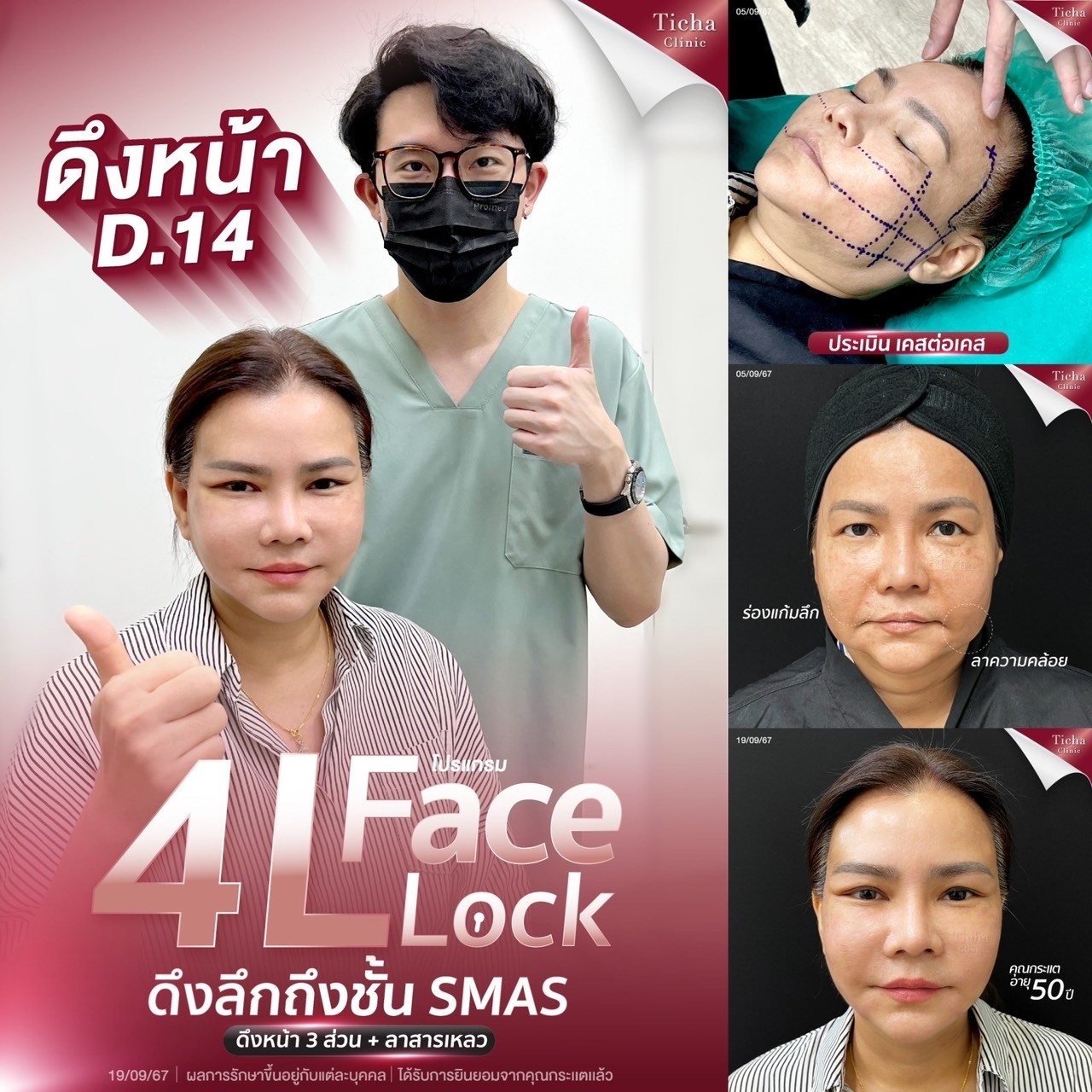 5ข้อควรรู้ก่อนดึงหน้า(2)