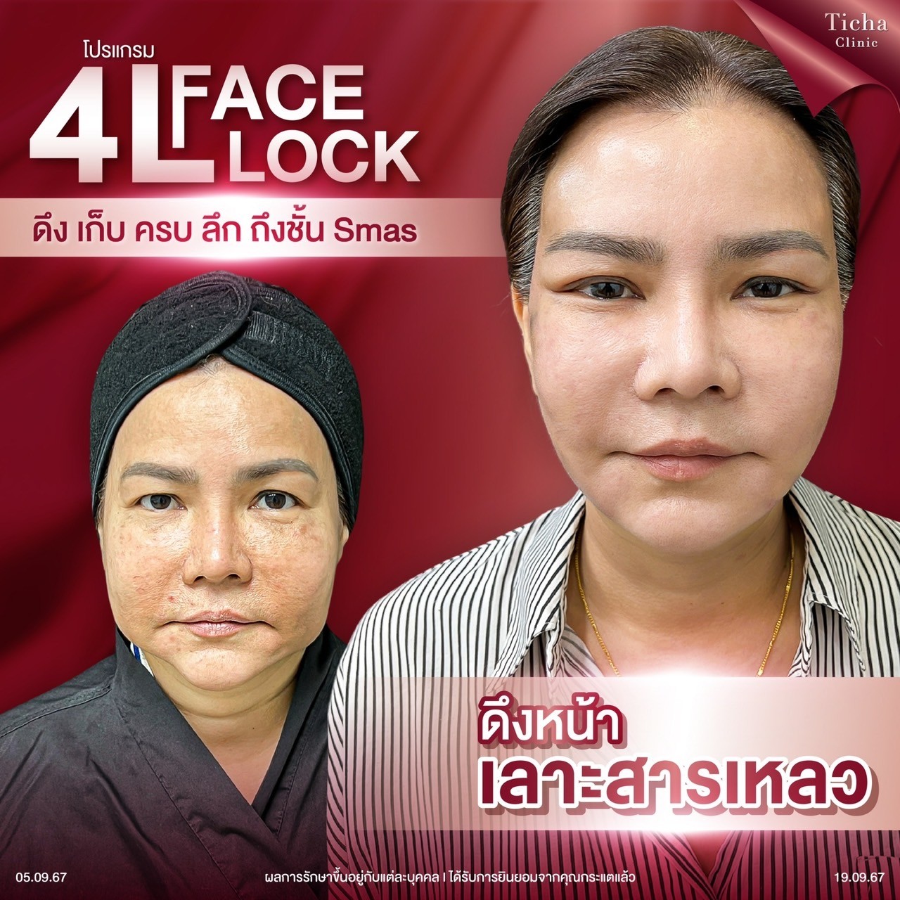 5ข้อควรรู้ก่อนดึงหน้า(3)