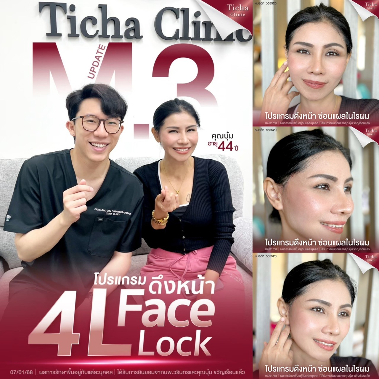 รอยแผลการผ่าตัดดึงหน้าจะหายไปภายในกี่วัน(3)