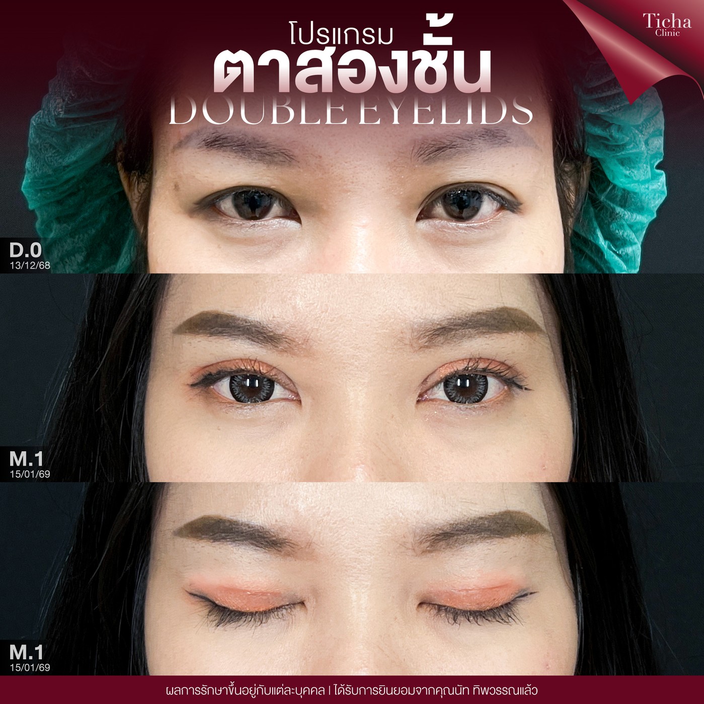 16.2 TC _ ทำตาสองชั้นเทคนิคกรีดสั้น vs กรีดยาว ต่างกันอย่างไร_ ตาแบบเราเหมาะกับเทคนิคไหน_