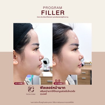 คุณนัตตี้-ฟิลเลอร์หน้าผาก
