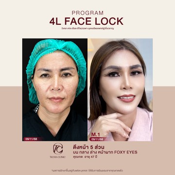 คุณเกด-ดึงหน้า