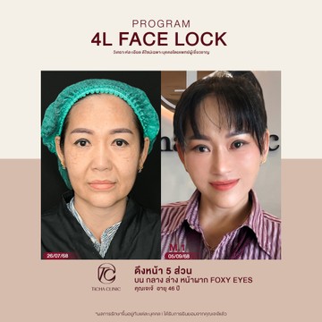 คุณเจเจ้-ดึงหน้า