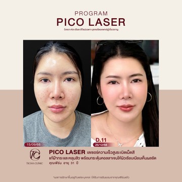 คุณเฟิร์น-pico
