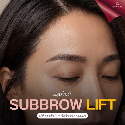 42.1 TC _ สรุปข้อดี Subbrow Lift ทำไมคนวัย 30+ ถึงนิยมทำมากกว่าการตัดหนังตาสองชั้นแบบเดิม ๆ