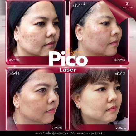 58.5 TC _ เทียบกันชัด ๆ_ Pico Laser vs เลเซอร์รุ่นเก่า Q-Switched ต่างกันอย่างไร ทำไม Pico ถึงเห็นผลไวกว่า_
