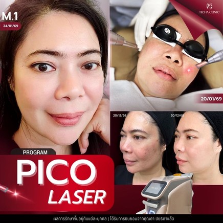 58.3 TC _ เทียบกันชัด ๆ_ Pico Laser vs เลเซอร์รุ่นเก่า Q-Switched ต่างกันอย่างไร ทำไม Pico ถึงเห็นผลไวกว่า_