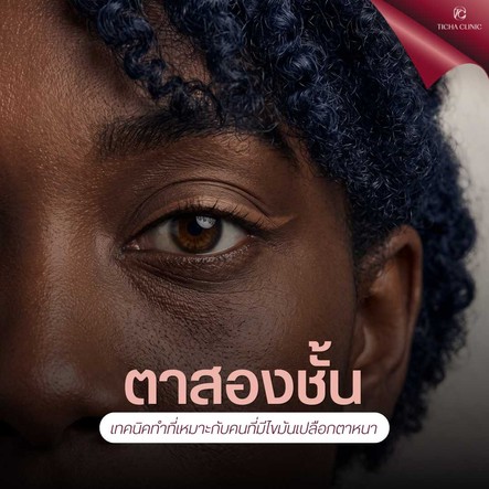 28.3 TC _ ตื่นมาแล้วตาบวมตุ่ยเหมือนคนไม่ได้นอน_ เจาะลึกวิธีแก้ปัญหา _ไขมันเปลือกตาหนา_ ด้วยการทำตาสองชั้น