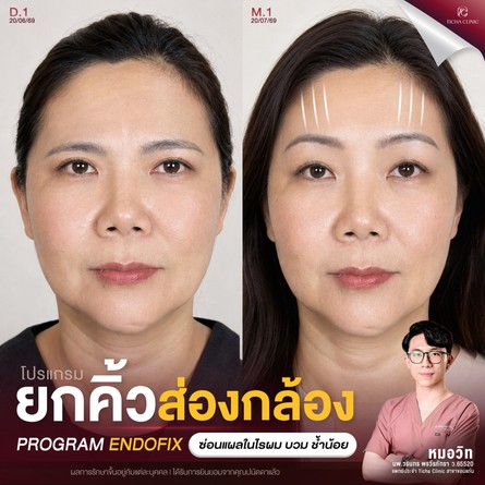 60.5 TC _ ยกกระชับด้วย Endotine อยู่ได้นานกี่ปี_ สรุปข้อดีของการยกคิ้วดึงหน้าผากแบบไม่ตัดหนังหน้าผาก