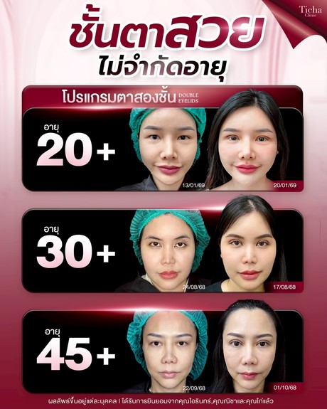 LINE_ALBUM_ศัล ตา2ชั้น - TICHA CLINIC_260808_2