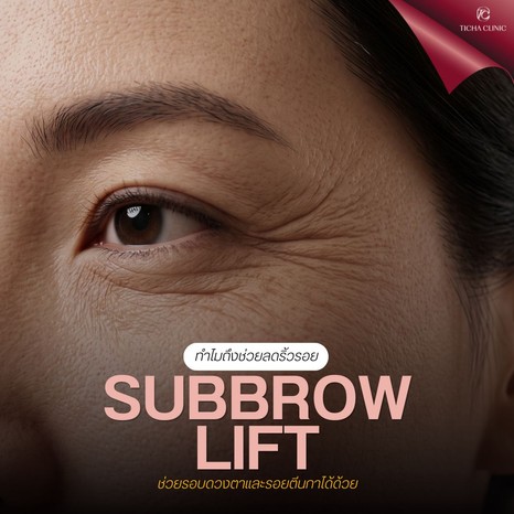 4.1 TC _ ทำไม Subbrow Lift ถึงช่วยลดริ้วรอยรอบดวงตาและรอยตีนกาได้ด้วย_