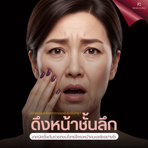 15.1 TC _ หน้าหย่อนคล้อยจากกรรมพันธุ์หรืออายุ_ ดึงหน้า SMAS เทคนิคดั้งเดิมช่วยตอบโจทย์โครงหน้าคนเอเชียอย่างไร