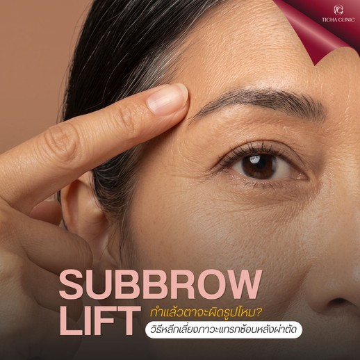 45.1 TC _ Subbrow Lift ทำแล้วตาจะผิดรูปไหม_ วิธีหลีกเลี่ยงภาวะแทรกซ้อนหลังผ่าตัด