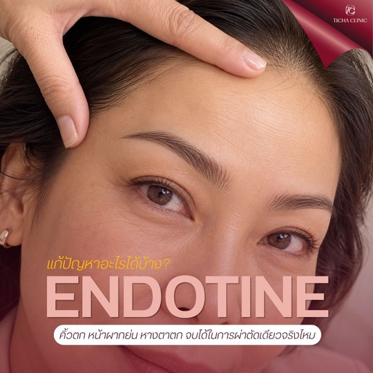 9.1 TC _ ยกคิ้ว Endotine แก้ปัญหาอะไรได้บ้าง_ คิ้วตก หน้าผากย่น หางตาตก จบได้ในการผ่าตัดเดียวจริงไหม
