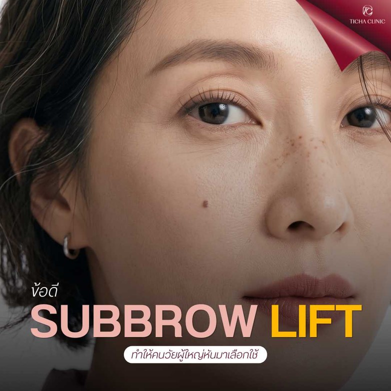 42.2 TC _ สรุปข้อดี Subbrow Lift ทำไมคนวัย 30+ ถึงนิยมทำมากกว่าการตัดหนังตาสองชั้นแบบเดิม ๆ