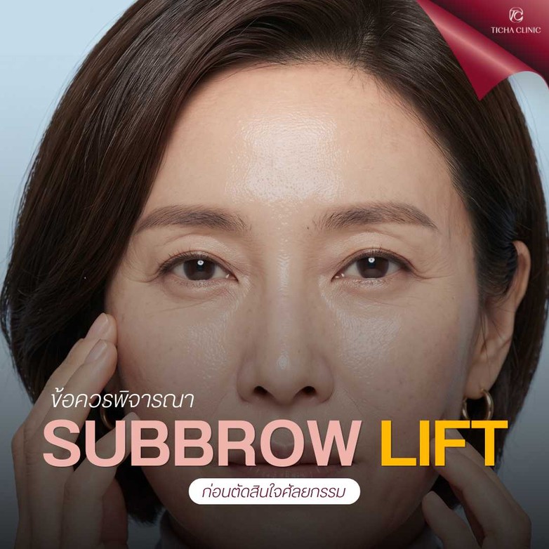 42.3 TC _ สรุปข้อดี Subbrow Lift ทำไมคนวัย 30+ ถึงนิยมทำมากกว่าการตัดหนังตาสองชั้นแบบเดิม ๆ