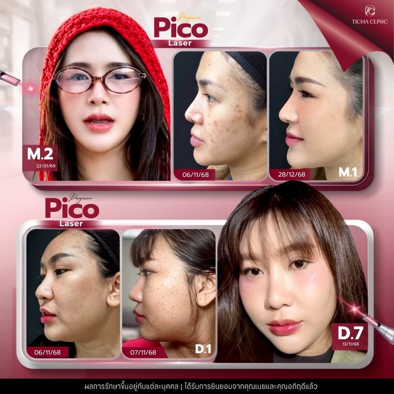 58.4 TC _ เทียบกันชัด ๆ_ Pico Laser vs เลเซอร์รุ่นเก่า Q-Switched ต่างกันอย่างไร ทำไม Pico ถึงเห็นผลไวกว่า_