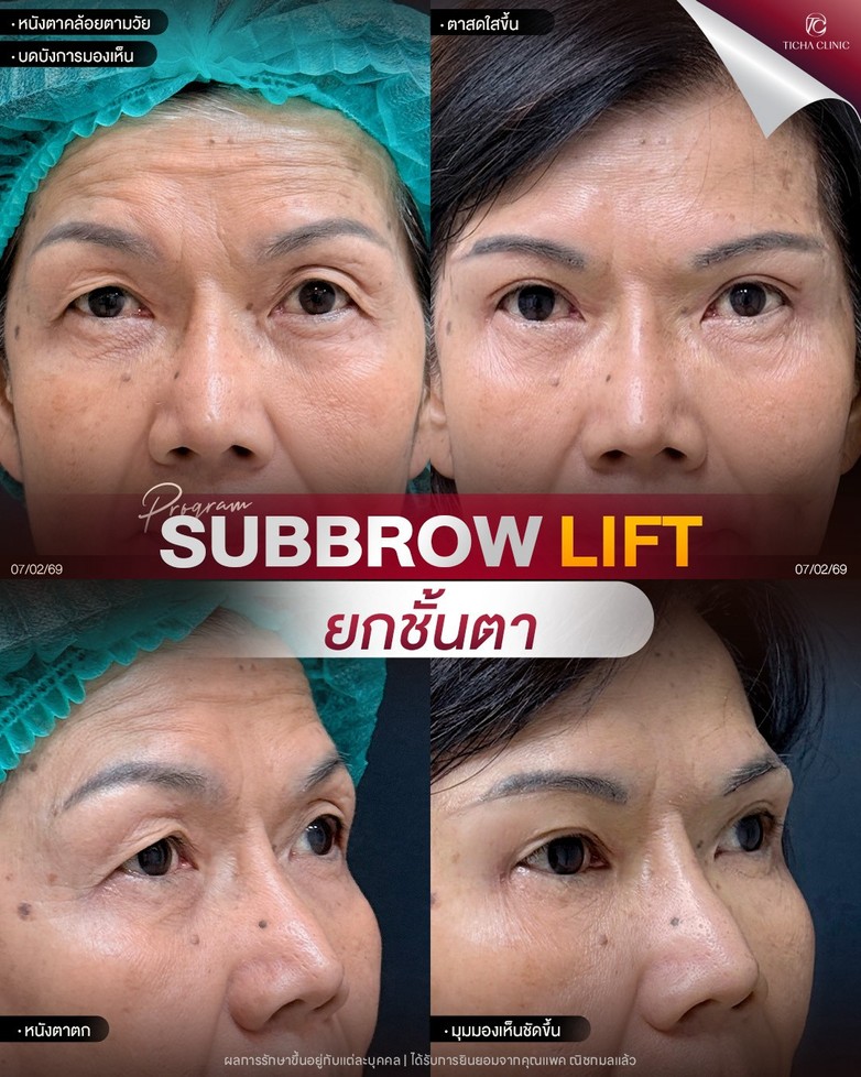 LINE_ALBUM_ซับบราว-Subbrow TC_261021_1