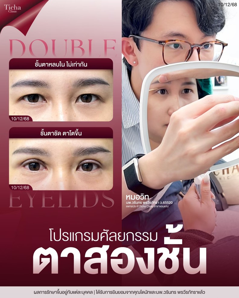 LINE_ALBUM_ศัล ตา2ชั้น - TICHA CLINIC_260909_1