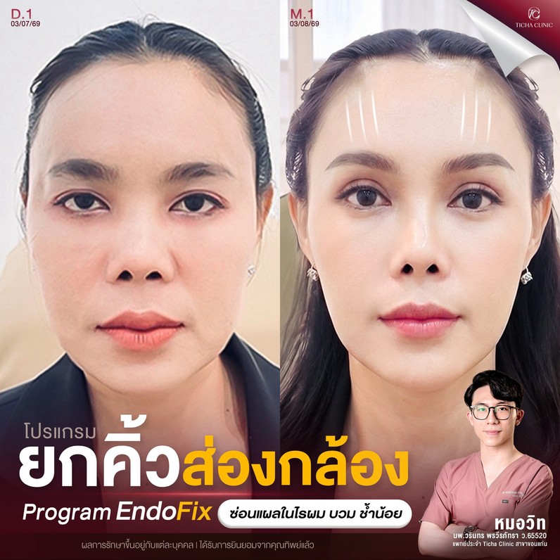 60.4 TC _ ยกกระชับด้วย Endotine อยู่ได้นานกี่ปี_ สรุปข้อดีของการยกคิ้วดึงหน้าผากแบบไม่ตัดหนังหน้าผาก