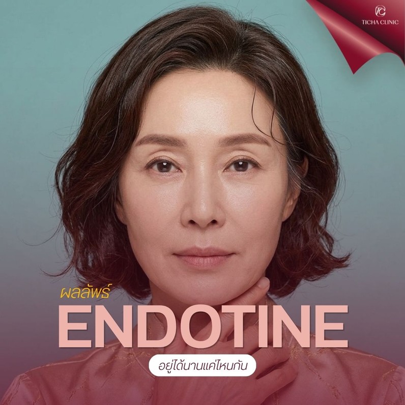 60.2 TC _ ยกกระชับด้วย Endotine อยู่ได้นานกี่ปี_ สรุปข้อดีของการยกคิ้วดึงหน้าผากแบบไม่ตัดหนังหน้าผาก