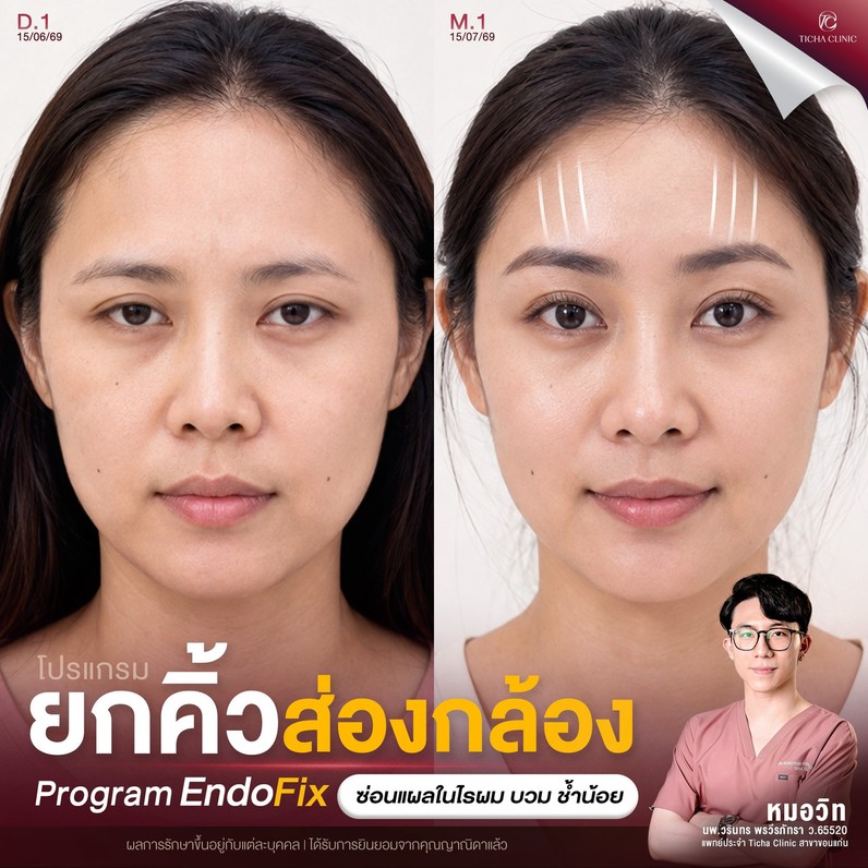 60.3 TC _ ยกกระชับด้วย Endotine อยู่ได้นานกี่ปี_ สรุปข้อดีของการยกคิ้วดึงหน้าผากแบบไม่ตัดหนังหน้าผาก