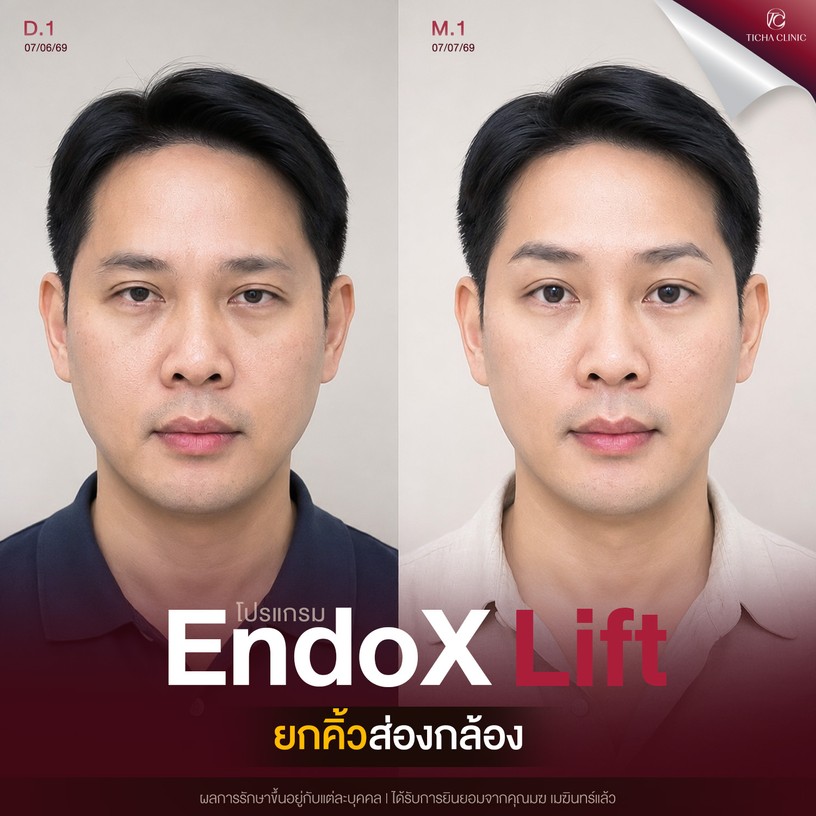 คุณเมฆ EndoX lift ยกคิ้วส่องกล้อง
