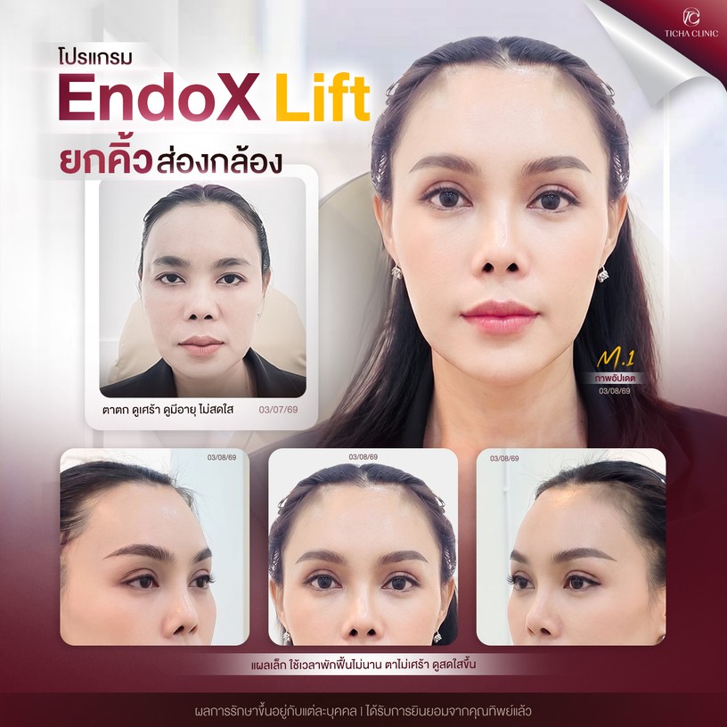 โปรแกรม EndoX lift ยกคิ้วส่องกล้อง 4