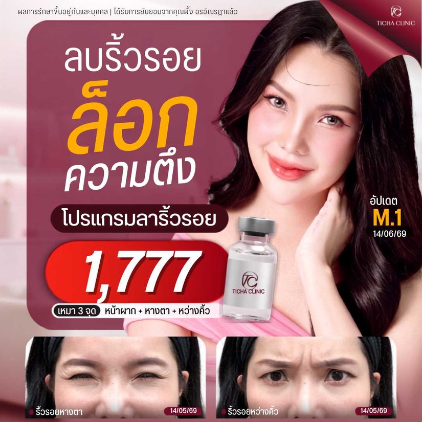 23.5 TC _ ริ้วรอยหน้าผากและหว่างคิ้ว คืนความเรียบเนียนด้วยโบท็อกซ์เทคนิคธรรมชาติตาไม่ตก