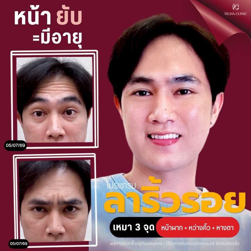 23.4 TC _ ริ้วรอยหน้าผากและหว่างคิ้ว คืนความเรียบเนียนด้วยโบท็อกซ์เทคนิคธรรมชาติตาไม่ตก