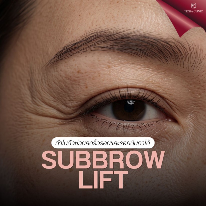 4.2 TC _ ทำไม Subbrow Lift ถึงช่วยลดริ้วรอยรอบดวงตาและรอยตีนกาได้ด้วย_